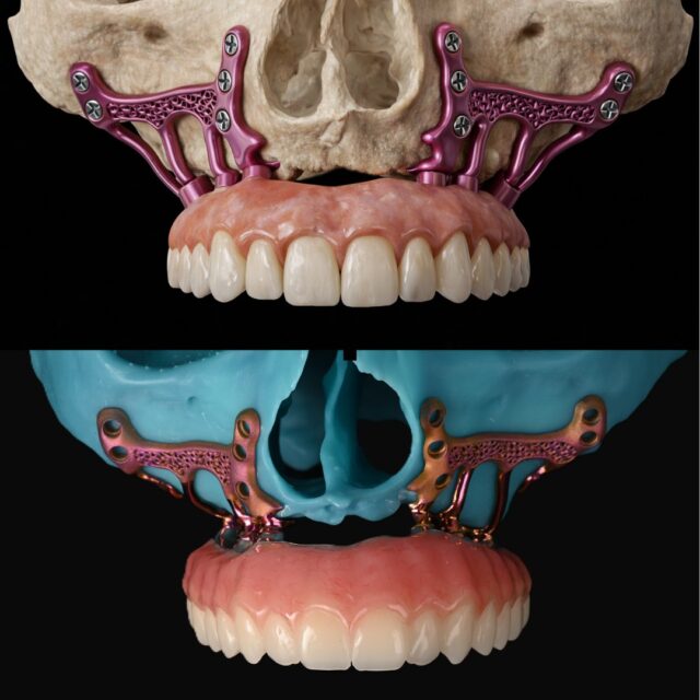 🦷 Une nouvelle ère dans le traitement de l’atrophie maxillaire sévère

Les implants sous-périostés numériques permettent de traiter des cas pour lesquels les solutions conventionnelles échouent.
Les patients peuvent quitter l’intervention avec une prothèse fixe définitive, restaurant immédiatement la fonction et l’esthétique.
Les premières publications scientifiques sur ce concept remontent à près de 10 ans.

🔬 Implant sous-périosté HUG® — développé en collaboration avec Biotech Dental — points clés :
• Structure en treillis → favorise la croissance osseuse
• Ancrage ptérygoïdien → améliore la biomécanique
• Comblement osseux → favorise l’intégration intra-osseuse
• Intégration tissulaire améliorée → réduction du risque de récession

➡️ De l’atrophie sévère… à la réhabilitation fixe immédiate.

🎥 Découvrez la procédure chirurgicale complète sur le site du Subperiosteal Institute — désormais disponible gratuitement.

#Implantologie #DentisterieNumérique #ImplantsSousPériostés #AtrophieMaxillaire #ConceptHUG #BiotechDental #ChirurgieOrale #InnovationDentaire #RéhabilitationComplète #MiseEnChargeImmédiate